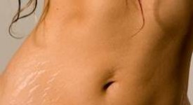 smagliature trattamenti combinati radiofrequenza peeling