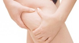 cellulite