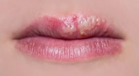 herpes labiale